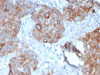IHC staining of FFPE human prostate carcinoma with STAT2 antibody. HIER: boil tissue sections in pH 9 10mM Tris with 1mM EDTA for 20 min and allow to cool before testing.