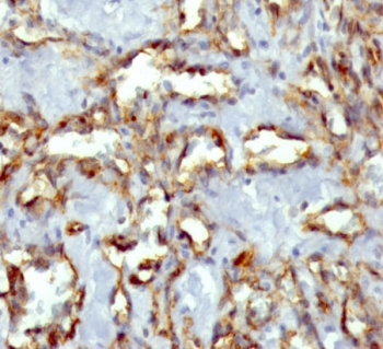 IHC staining of FFPE human angiosarcoma with CD31 antibody (clone C31.3 + JC/70A). HIER: boil tissue sections in pH 9 10mM Tris with 1mM EDTA for 20 min and allow to cool before testing.