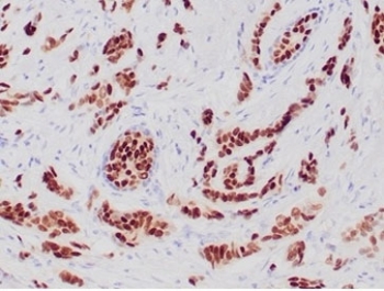 IHC staining of FFPE human breast carcinoma tissue with recombinant Progesterone Receptor antibody (clone PGR/6854R). HIER: boil tissue sections in pH 9 10mM Tris with 1mM EDTA for 20 min and allow to cool before testing.
