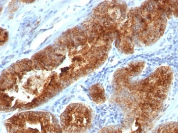 IHC: Formalin-fixed, paraffin-embedded human prostate carcinoma stained with TAG-72 antibody (B72.3 + CC49).