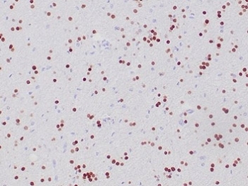 IHC staining of FFPE human oligodendroglioma tissue with recombinant OLIG2 antibody (clone OLIG2/6695R). HIER: boil tissue sections in pH 9 10mM Tris with 1mM EDTA for 20 min and allow to cool before testing.