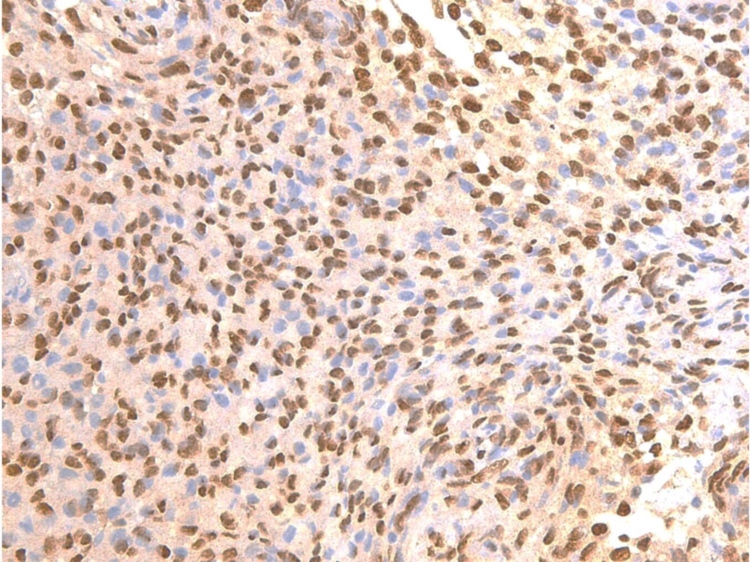 Formaldehyde-fixed, paraffin-embedded human pituitary carcinoma stained with EGFR-pS671 Rabbit Polyclonal Antibody AE00301 at 10ug/ml for 1.5h at ambient temperature. Epitope retrieval: Pressure cooker heating at pH6 for 3min, then cool by running cold water for 10min. DAB staining by HRP.