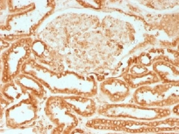 IHC testing of FFPE human renal cell carcinoma with Calnexin antibody. HIER: boil tissue sections in 10mM Tris with 1mM EDTA, pH 9.0 for 10-20 min.