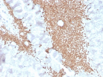 IHC staining of FFPE human colon carcinoma with recombinant SATB2 antibody (clone SATB2/4374R). HIER: boil tissue sections in pH 9 10mM Tris with 1mM EDTA for 20 min and allow to cool before testing.