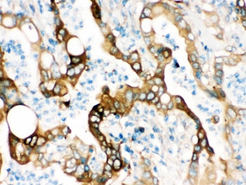 IHC testing of FFPE human intestinal cancer tissue with FASN antibody. HIER: Boil the paraffin sections in pH 6, 10mM citrate buffer for 20 minutes and allow to cool prior to staining.