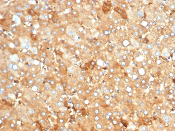 IHC staining of FFPE human liver carcinoma in colon with recombinant Albumin antibody (clone rALB/6412). HIER: boil tissue sections in pH 9 10mM Tris with 1mM EDTA for 20 min and allow to cool before testing.