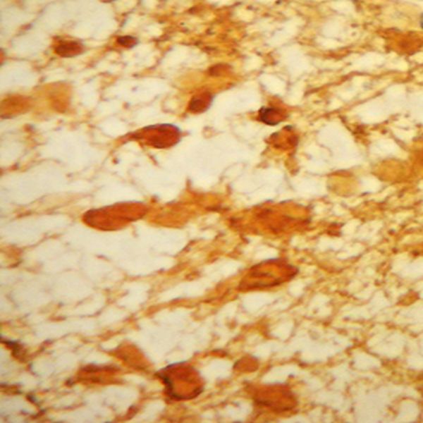 IHC image of a human astrocytoma staining for s-100 beta. The tissue was formalin fixed and embedded in paraffin, before microtome sectioning and antigen retrieval. Sections were incubated at RT in 10% goat serum in PBS, before standard IHC procedure. Primary antibody was incubated at 15000 for 48 hours, goat anti-rabbit secondary was subsequently added for 1 hour after washing with PBS. Light microscopy staining was achieved with standard biotin-streptavidin/HRP procedure and DAB chromogen.