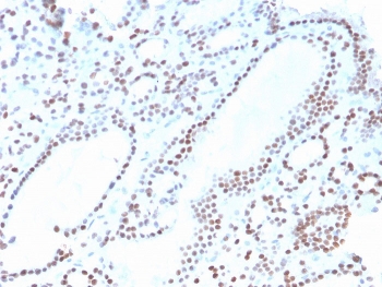 IHC staining of FFPE human thyroid with recombinant PAX8 antibody. HIER: boil tissue sections in pH 9 10mM Tris with 1mM EDTA for 20 min and allow to cool before testing.