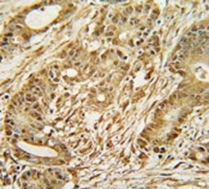 MCM2 antibody immunohistochemistry analysis in formalin fixed and paraffin embedded human colon carcinoma.