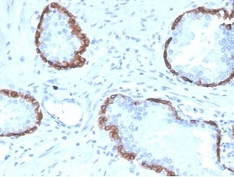 IHC staining of FFPE human prostate tissue with KRT14 antibody (clone KRT14/4128). HIER: boil tissue sections in pH 9 10mM Tris with 1mM EDTA for 20 min and allow to cool before testing.
