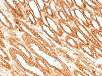 IHC testing of FFPE human renal cell carcinoma with Calnexin antibody. HIER: boil tissue sections in 10mM Tris with 1mM EDTA, pH 9.0 for 10-20 min.