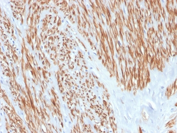 IHC staining of FFPE human leiomyosarcoma with recombinant CNN1 antibody. HIER: boil tissue sections in pH 9 10mM Tris with 1mM EDTA for 20 min and allow to cool before testing.