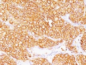 IHC: Formalin-fixed, paraffin-embedded human renal cell carcinoma stained with CA9 antibody (SPM314).