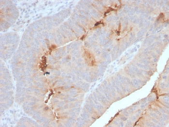 IHC staining of FFPE human colon carcinoma with recombinant SAA antibody. HIER: boil tissue sections in 10mM Tris with 1mM EDTA, pH 9, for 10-20 min and allow to cool before testing.