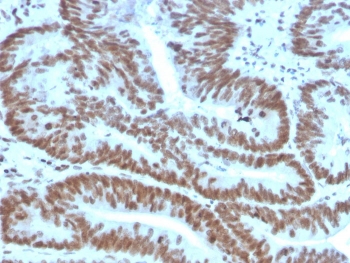 IHC staining of FFPE human colon carcinoma with BMI1 antibody. HIER: boil tissue sections in pH 9 10mM Tris with 1mM EDTA for 20 min and allow to cool before testing.