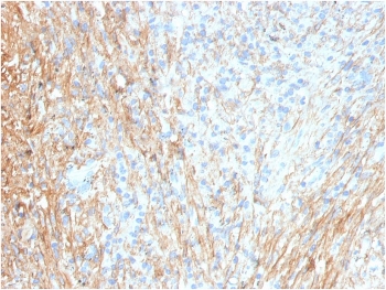 IHC staining of FFPE human lung with Fibronectin antibody (clone FN1/3036). HIER: boil tissue sections in pH 9 10mM Tris with 1mM EDTA for 20 min and allow to cool before testing.