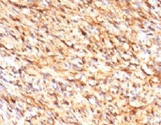 IHC testing of FFPE human schwanoma with S100 beta antibody (clone S100B/1012). Required HIER: boil tissue sections in pH 9 10mM Tris with 1mM EDTA for 10-20 min followed by cooling at RT for 20 min.