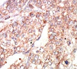 IHC analysis of FFPE human hepatocarcinoma tissue stained with the EphA1 antibody