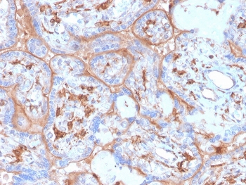 IHC staining of FFPE human placenta with recombinant PDL1 antibody (clone rPDL1/4773). HIER: boil tissue sections in pH 9 10mM Tris with 1mM EDTA for 20 min and allow to cool before testing.