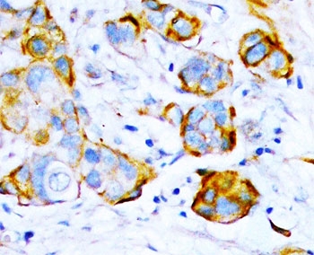 IHC-P: SHP2 antibody testing of human thyroid cancer tissue