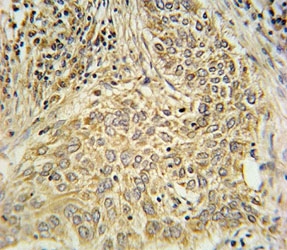 AHR antibody immunohistochemistry analysis in formalin fixed and paraffin embedded human lung carcinoma.
