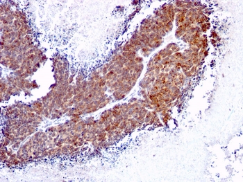 IHC staining of FFPE human melanoma with TOP1MT antibody (clone TOP1MT/613). HIER: boil tissue sections in pH 9 10mM Tris with 1mM EDTA for 20 min and allow to cool before testing.