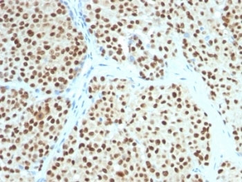 IHC testing of FFPE human melanoma with SOX10 antibody (clone SOX10/991). Required HIER: boil tissue sections in pH 9 10mM Tris with 1mM EDTA for 10-20 min followed by cooling at RT for 20 min. 