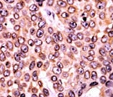 IHC analysis of FFPE human breast carcinoma tissue stained with the p-p21 antibody.