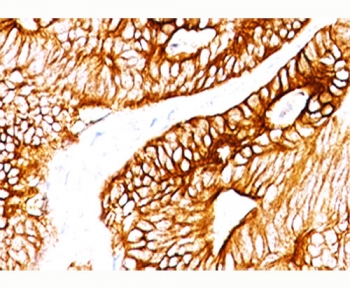 IHC staining of FFPE human colon carcinoma with Cytokeratin 8/18 antibody (K8.8 + DC10).
