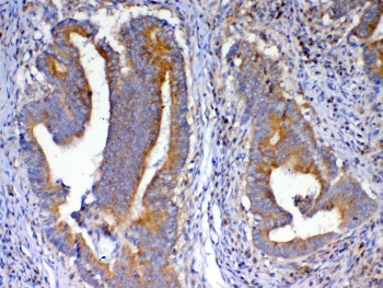 IHC testing of FFPE human intestinal cancer tissue with NSF antibody at 1ug/ml. Required HIER: steam section in pH6 citrate buffer for 20 min and allow to cool prior to testing.