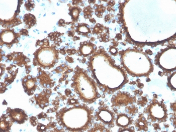 IHC staining of FFPE human thyroid carcinoma with TPO antibody. HIER: boil tissue sections in pH 9 10mM Tris with 1mM EDTA for 20 min and allow to cool before testing.