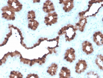IHC staining of FFPE human breast carcinoma with recombinant pS2 antibody (clone rTFF1/1091). HIER: boil tissue sections in pH 9 10mM Tris with 1mM EDTA for 20 min and allow to cool before testing.