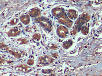DAB staining on IHC-P; Sample: Human Breast cancer Tissue;  Primary Ab: 10µg/ml Mouse Anti-Human HAVCR2 Antibody Second Ab: 2µg/mL HRP-Linked Caprine Anti-Mouse IgG Polyclonal Antibody (Catalog: SAA544Mu19)