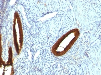 IHC: Formalin-fixed, paraffin-embedded human endometrial carcinoma stained with CK19 antibody (KRT19/800)