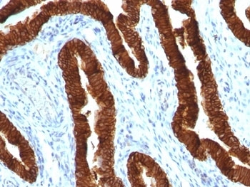 IHC: Formalin-fixed, paraffin-embedded human ovarian carcinoma stained with CK19 antibody (clone KRT19/800).