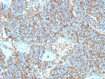 IHC staining of FFPE human Ewings sarcoma with recombinant CD99 antibody (clone rMIC2/3317). HIER: boil tissue sections in pH 9 10mM Tris with 1mM EDTA for 20 min and allow to cool before testing.