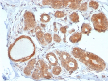 IHC staining of FFPE human breast carcinoma with STAT5b antibody. HIER: boil tissue sections in pH 9 10mM Tris with 1mM EDTA for 20 min and allow to cool before testing.