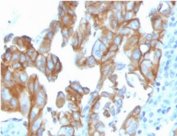 IHC staining of FFPE human colon carcinoma with MerTK antibody (clone TPKR-1). HIER: boil tissue sections in pH 9 10mM Tris with 1mM EDTA for 10-20 min and allow to cool before testing.
