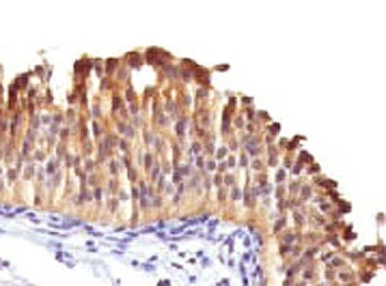 IHC testing of human bladder carcinoma with Cytokeratin 10 antibody (clone DE-K10).