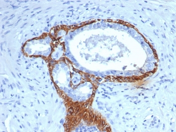 IHC staining of FFPE human prostate tissue with CK14 antibody (clone KRT14/4133). HIER: boil tissue sections in pH 9 10mM Tris with 1mM EDTA for 20 min and allow to cool before testing.
