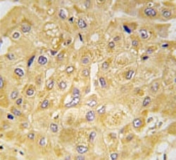 IHC analysis of FFPE human hepatocarcinoma tissue stained with Integrin linked kinase antibody