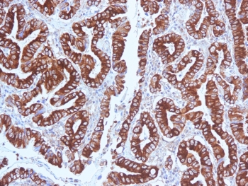 IHC testing of FFPE human gastric carcinoma with MUC5AC antibody (clone CLH2). Required HIER: steam section in pH 9 10mM Tris with 1mM EDTA for 20 min and allow to cool prior to testing.