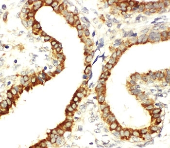 IHC-P: Integrin beta 3 antibody testing of human breast cancer tissue