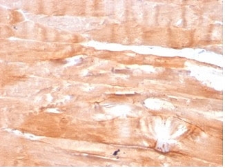 IHC staining of FFPE human skeletal muscle tissue with DMD antibody (clone DMD/3676). HIER: boil tissue sections in pH 9 10mM Tris with 1mM EDTA for 20 min and allow to cool before testing.