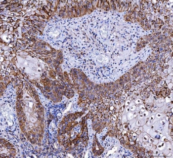 IHC staining of FFPE human laryngeal squamous cell carcinoma tissue with Basigin antibody. HIER: boil tissue sections in pH8 EDTA for 20 min and allow to cool before testing.