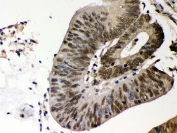 IHC testing of FFPE human intestinal cancer tissue with CSNK1A1 antibody. HIER: Boil the paraffin sections in pH 6, 10mM citrate buffer for 20 minutes and allow to cool prior to staining.