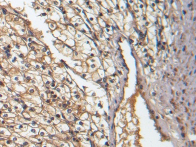 DAB staining on IHC-P; Sample: Human Renal cancer Tissue;  Primary Ab: 20µg/ml Mouse Anti-Human BMP7 Antibody Second Ab: 2µg/mL HRP-Linked Caprine Anti-Mouse IgG Polyclonal Antibody (Catalog: SAA544Mu19)