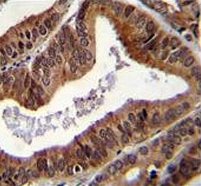 IHC testing of FFPE human prostate carcinoma tissue with Tyrosyl-DNA phosphodiesterase 2 antibody. HIER: steam section in pH6 citrate buffer for 20 min and allow to cool prior to staining.