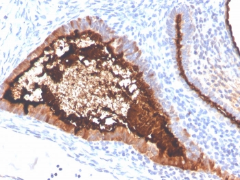 IHC staining of FFPE human ovarian carcinoma with recombinant MUC16 antibody (clone OCA125/4505R). HIER: boil tissue sections in pH 9 10mM Tris with 1mM EDTA for 20 min and allow to cool before testing.