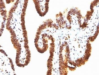 IHC: Formalin-fixed, paraffin-embedded human ovarian carcinoma stained with anti-SUMO-1 antibody (clone SPM571).